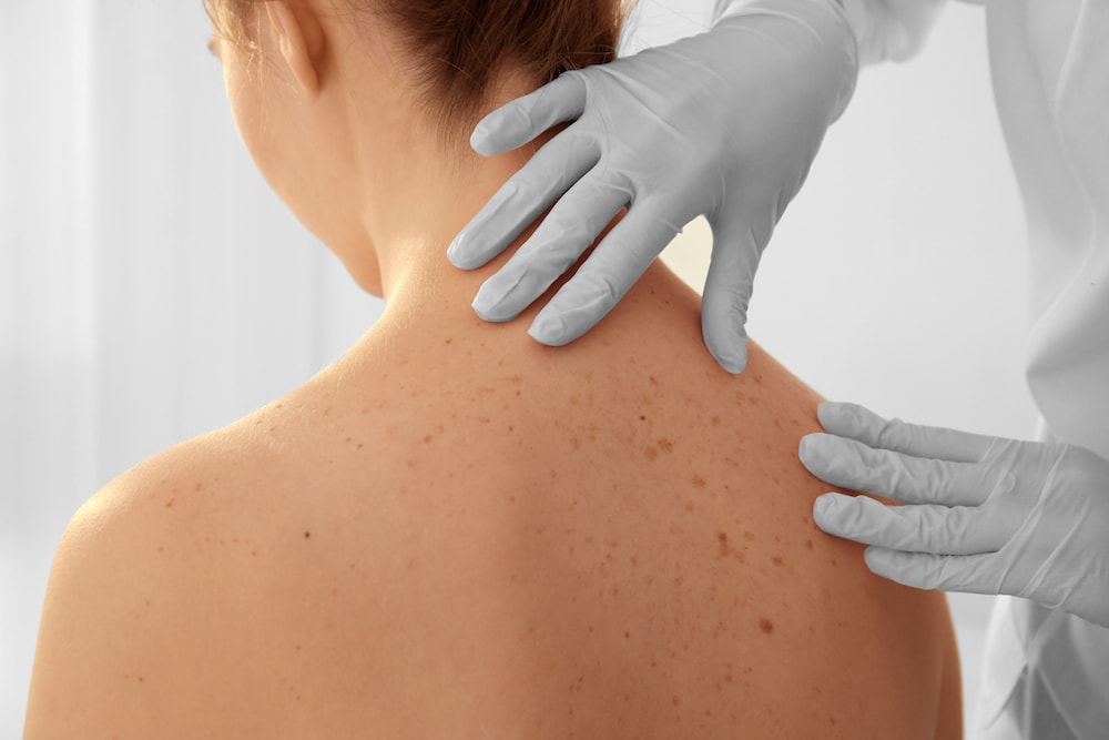 to The Skin Mole Clinic Mole Clinic Joondalup, mole check